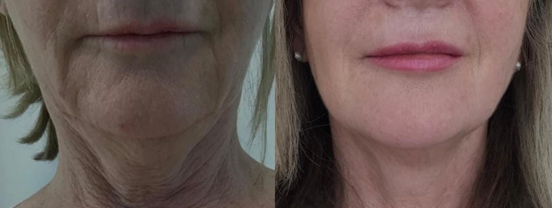 Before and after Focus Lift facial treatment